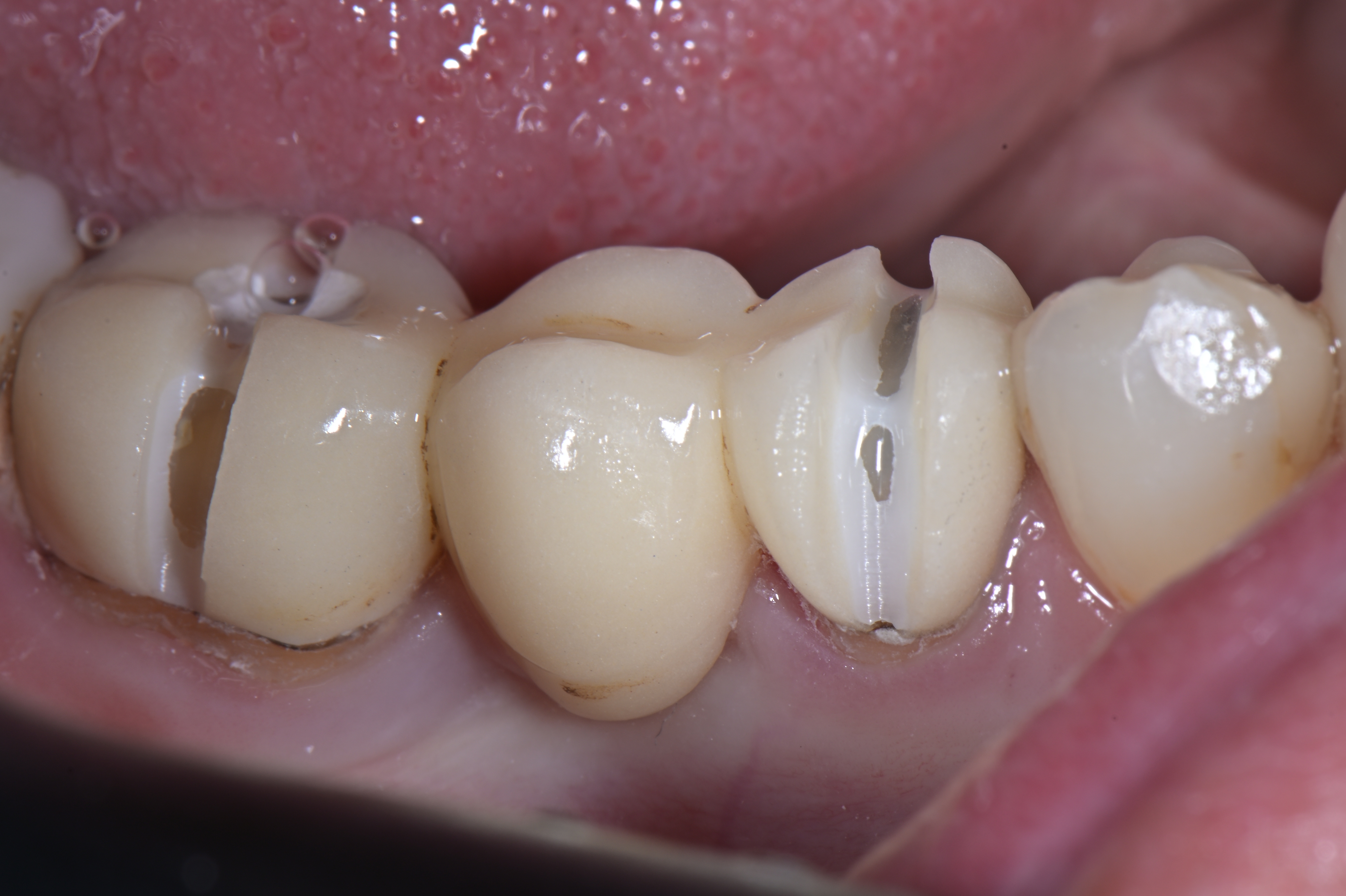 Thumbnail for ZirconCut Prosthetic Set