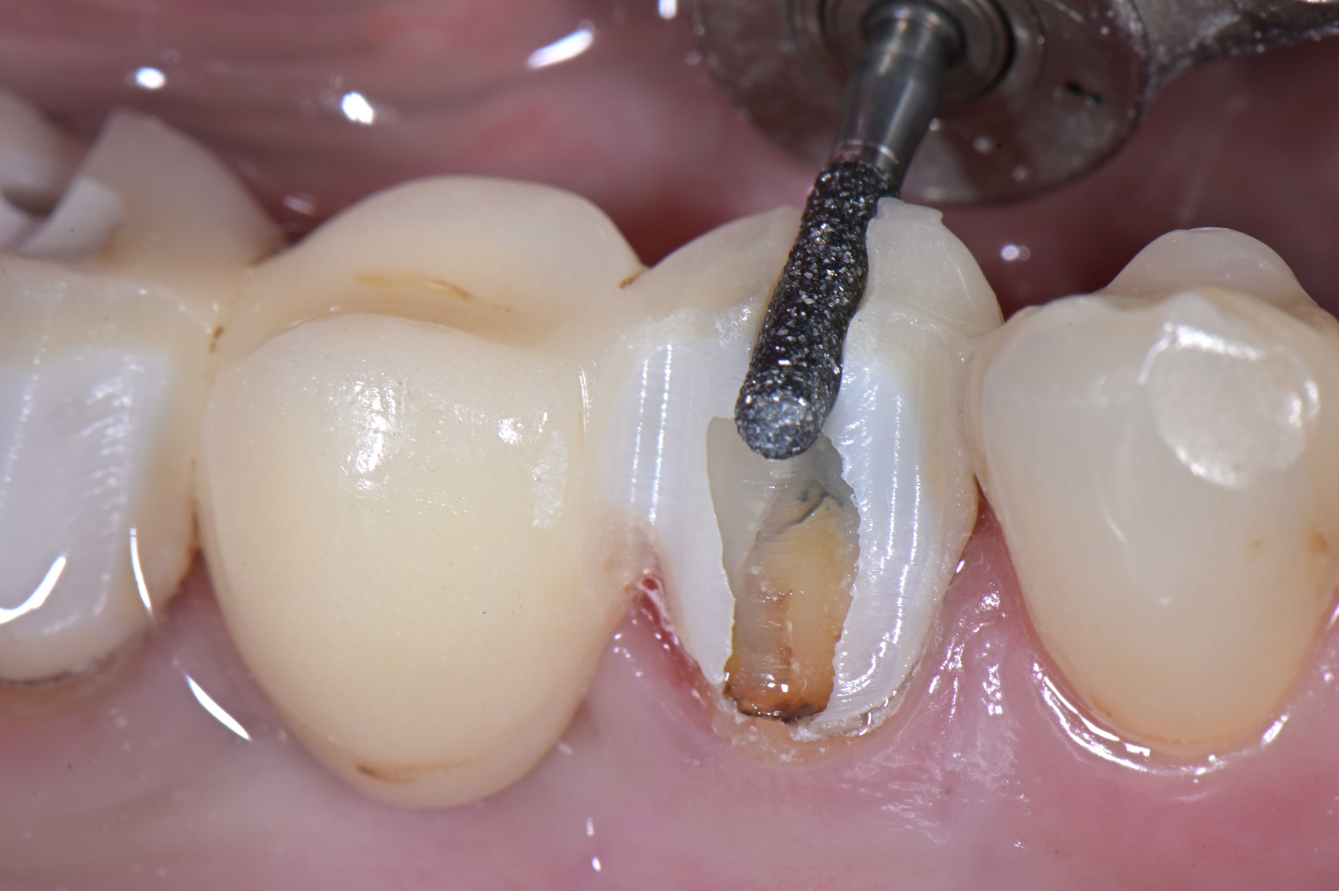 ZirconCut Prosthetic Set