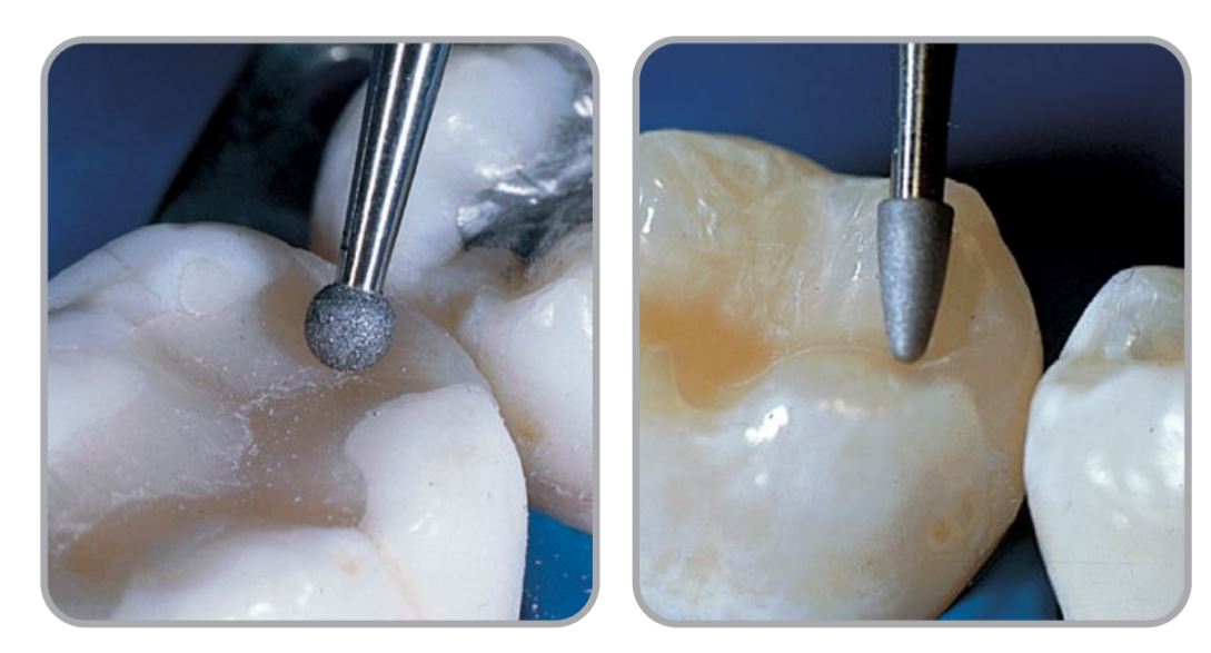 Thumbnail for Intensiv Composhape Set Anterior &amp; Posterior