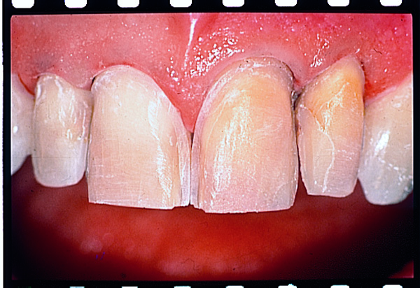 Thumbnail for Intensiv Modular veneer Set