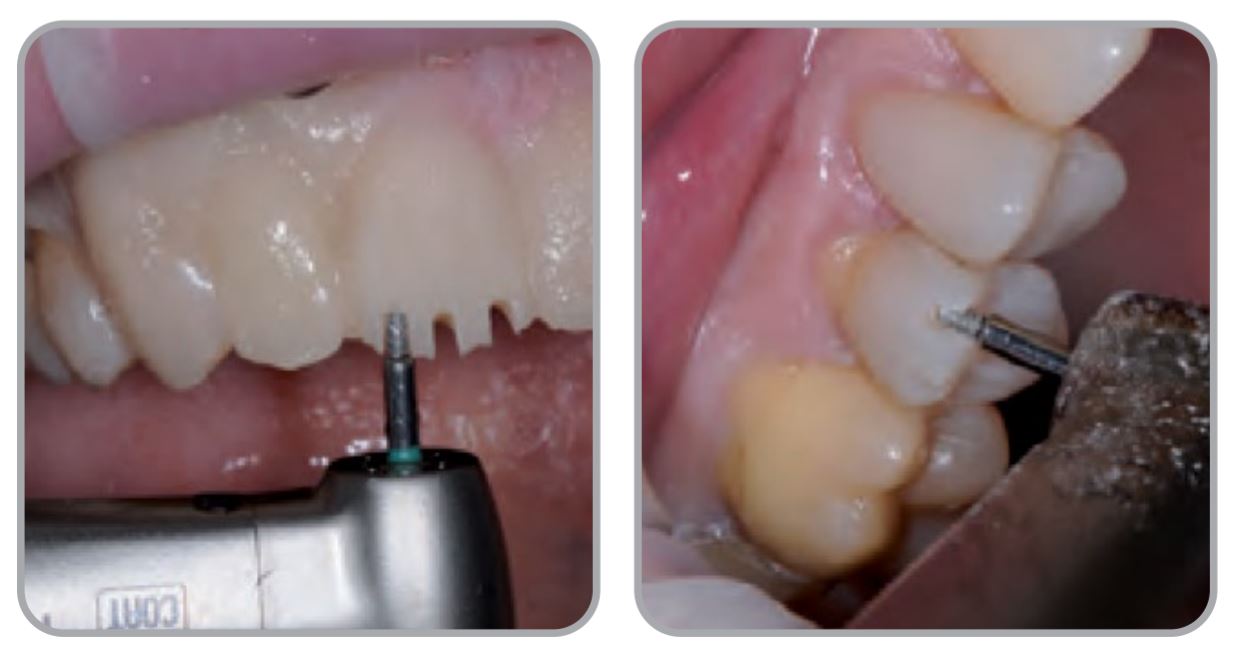 Thumbnail for Intensiv Universal full Crown and Porcelain Veneer Prep Set