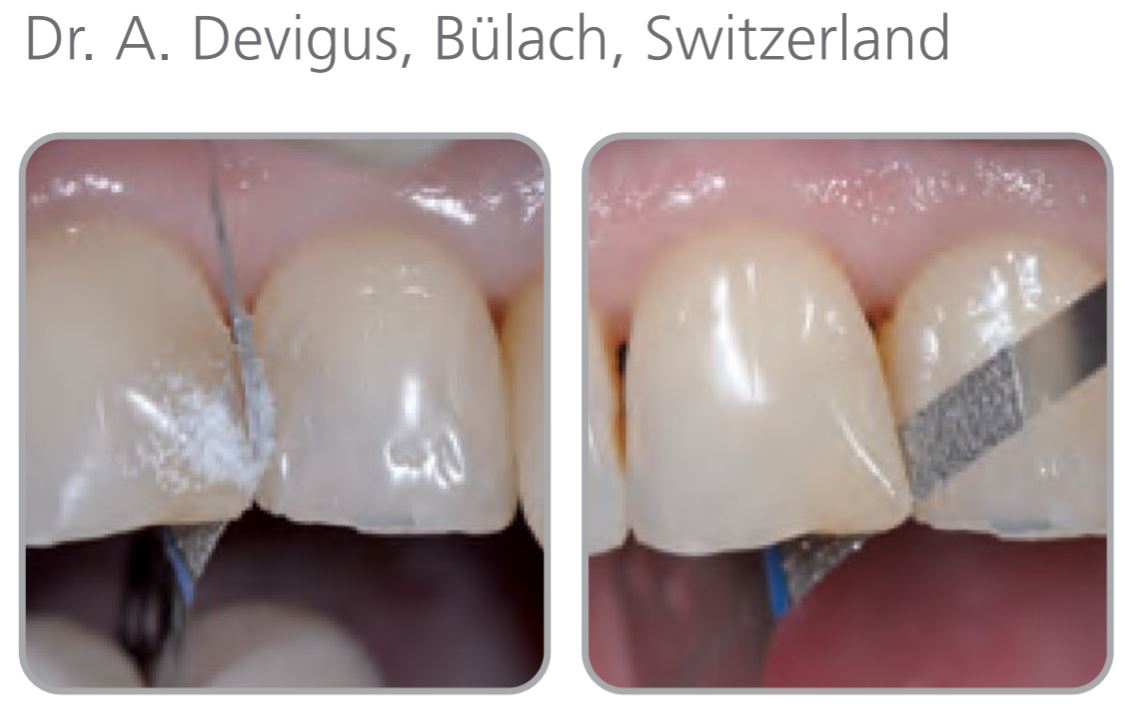 Thumbnail for Intensiv Proxo Contour Coarse