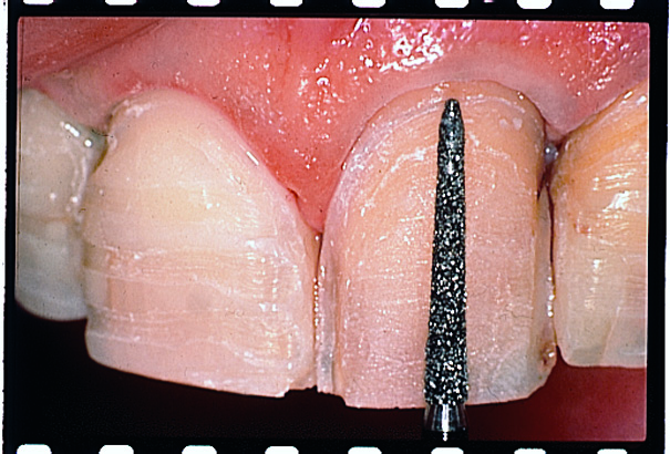Thumbnail for Intensiv Modular veneer Set